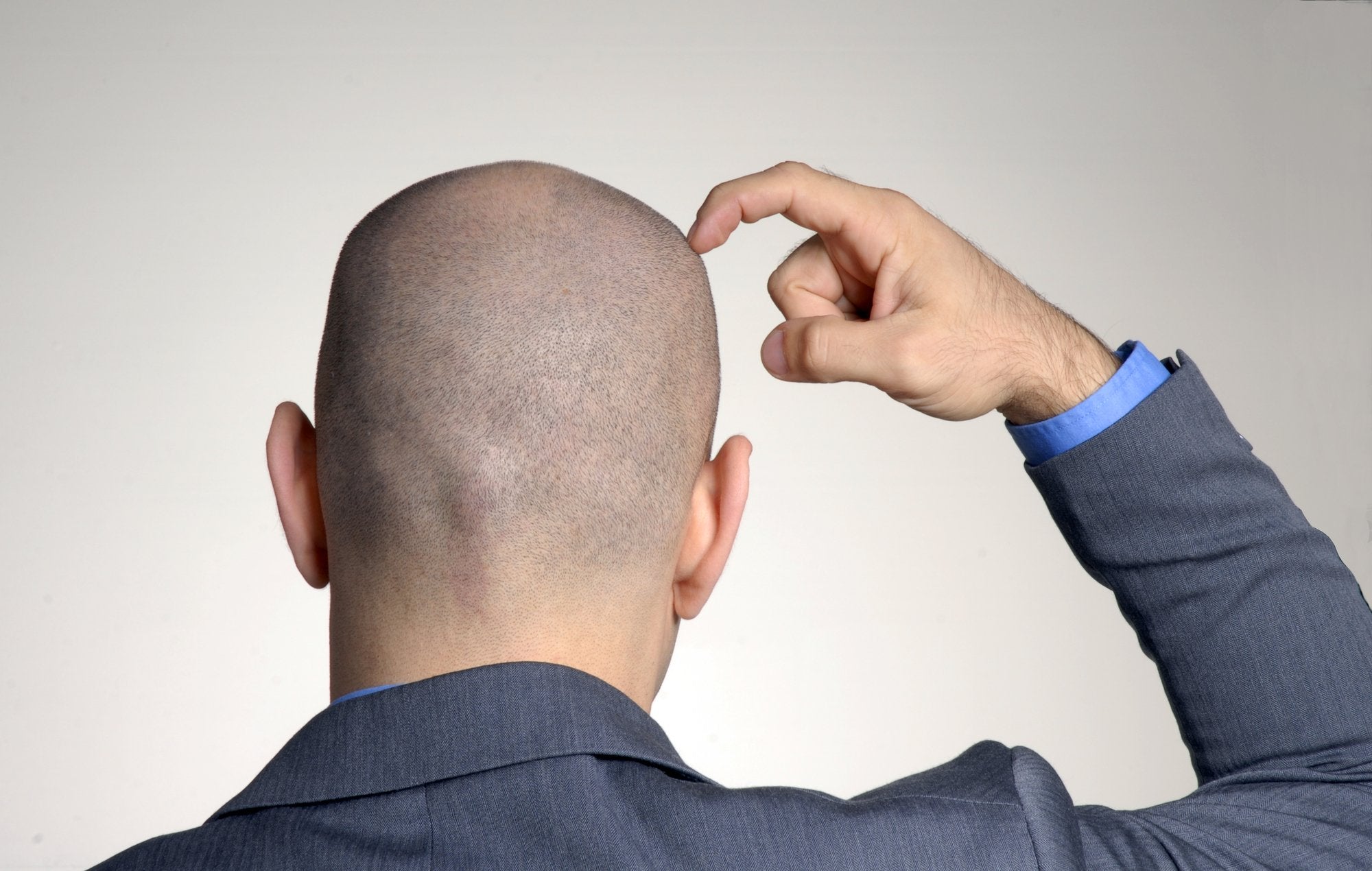 going bald at 20 how to deal with it? a bald man touching his head